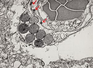 M,71y. | CADASIL accompanied with Alzheimer disease - brain vessel - arrows: granular osmiophilic material (GOM) between basement membranes